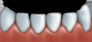 Dental bonding can be used to fix teeth that are chipped.