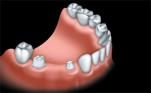 With a traditional bridge, healthy teeth on each side of the missing tooth are prepared for crowns.