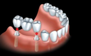 A custom-made bridge is anchored to the dental implants.
