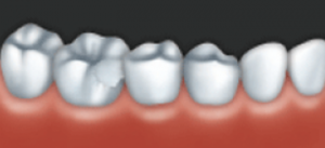 A crown can be used to restore a damaged tooth.