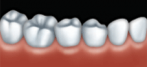 The final crown is cemented into place. It looks and works very much like a natural tooth.