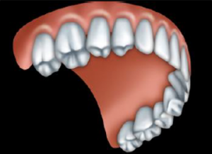 A full upper denture