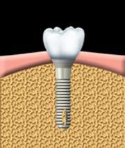 An artificial tooth is attached to the abutment. Properly fitting the artificial tooth may take several appointments.