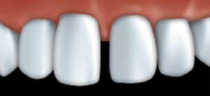 Veneers can be used to fill gaps.