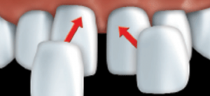 The custom-made porcelaine veneers are glued to your teeth one by one with a composite resin cement.