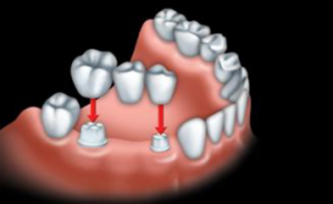 The custom-made artificial tooth is fused to 2 crowns. This is called a bridge.