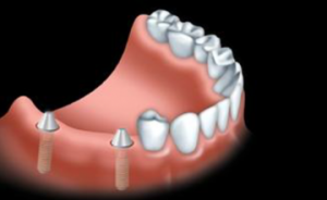 With an implant bridge, dental implants are surgically placed into the jawbone.