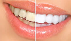 teeth-whitening1